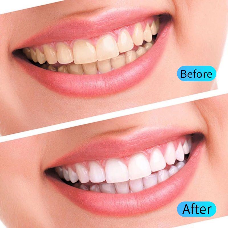 Teeth Whitening Gel Kit Oral H - Teeth Whitening Kit At Home のレビューと価格