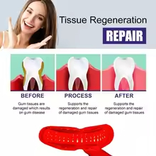 Laser Treatment for Periodonta - Teeth Whitening Laser Treatment のレビューと価格