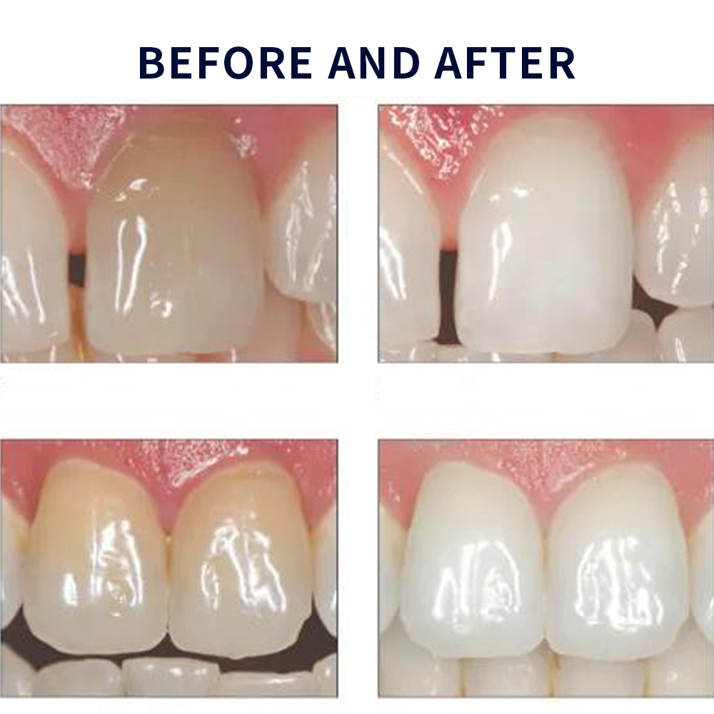 Opalescence Whitening 20% PF 2 - Teeth Whitening With Hydrogen Peroxide のレビューと価格