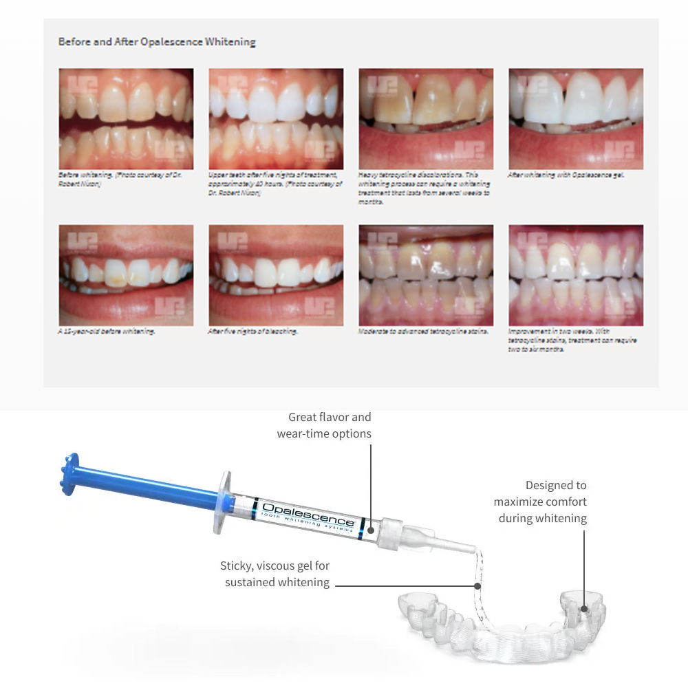 Opalescence Whitening 20% PF 2 - Teeth Whitening With Hydrogen Peroxide のレビューと価格