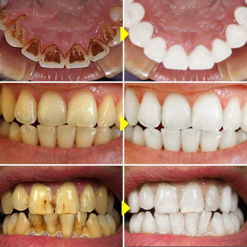 V34 Teeth Whitening Mousse Too - Teeth Whitening Xylitol のレビューと価格