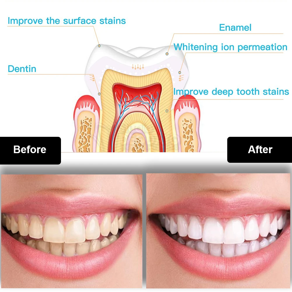 Dental Teeth Whitening Kit Min - Teeth Whitening With Hydrogen Peroxide のレビューと価格