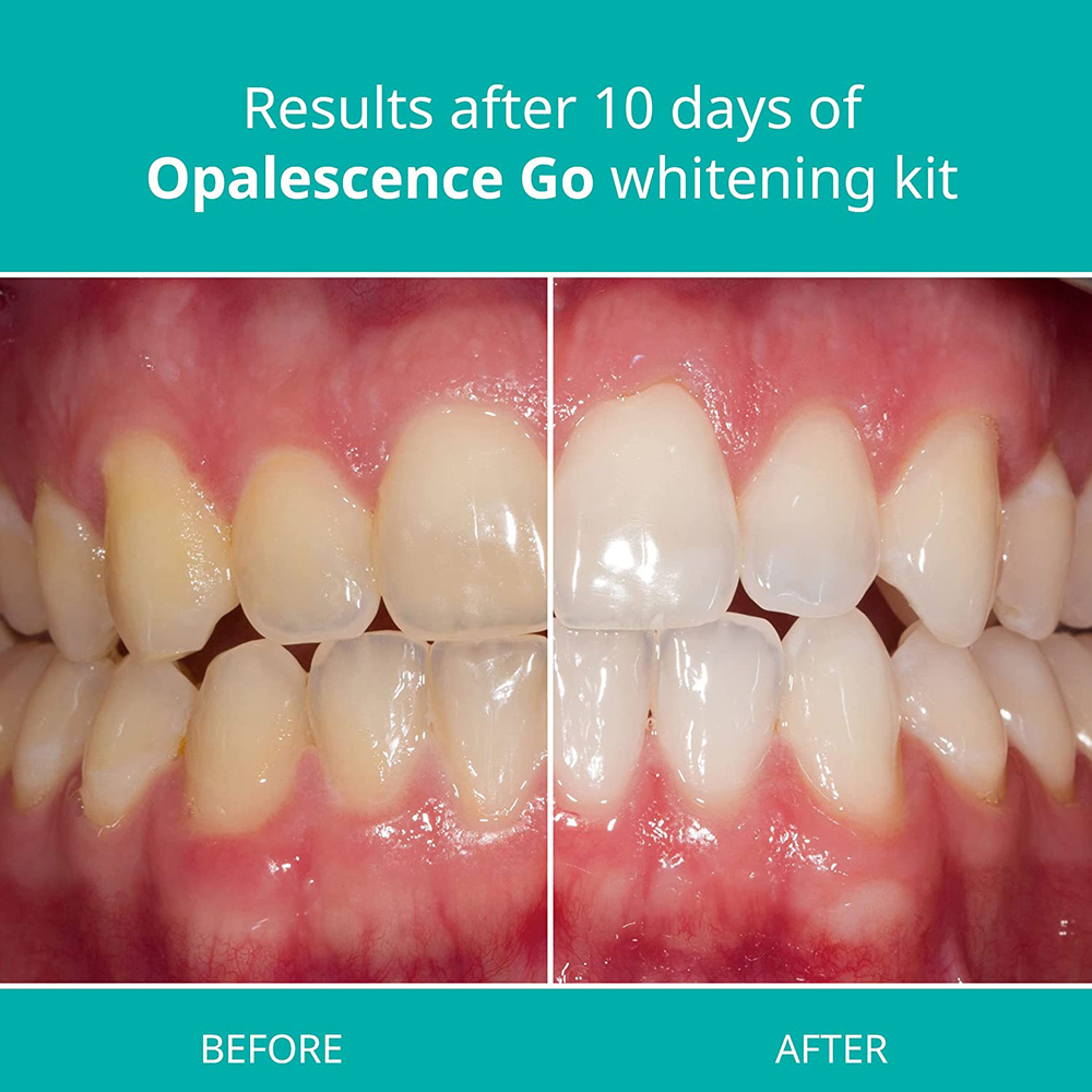Opalescence Go Teeth Whitening - Teeth Whitening Kit At Home のレビューと価格